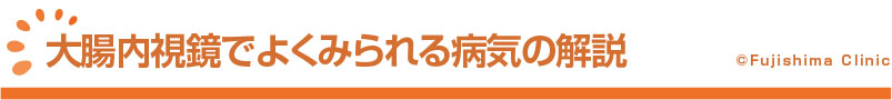 大腸内視鏡でよくみられる病気の解説
